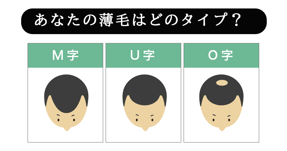 あなたの薄毛はどのタイプ型？M型？つむじ型？